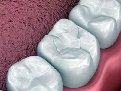 Προστασία των δοντιών από την τερηδόνα