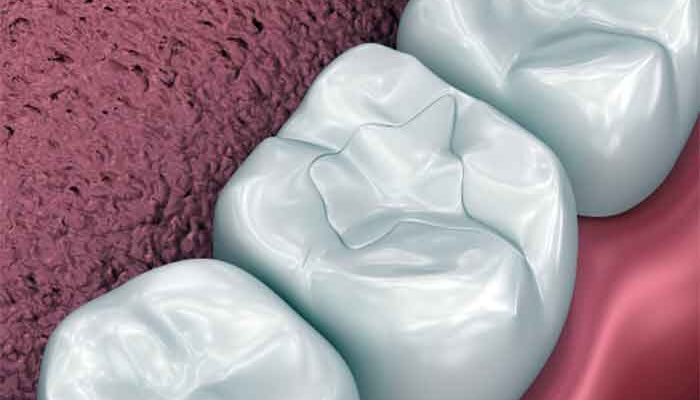 Προστασία των δοντιών από την τερηδόνα