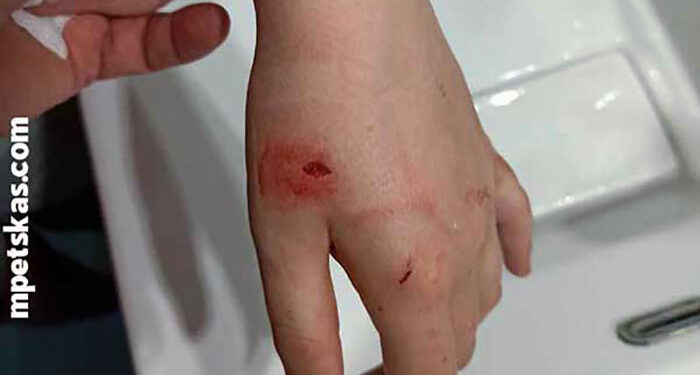 Σκύλος δάγκωσε κοριτσάκι – Στο νοσοκομείο Καστοριάς με τραύματα στα χέρια