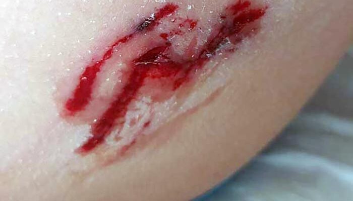 Αδέσποτο τσομπανόσκυλο δάγκωσε δύο 8χρονα παιδιά στη Καστόρια